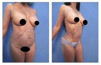 High Definition Liposuction Revision