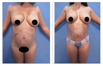 Best Liposuction Revision  Cosmetic Plastic Surgery Institute