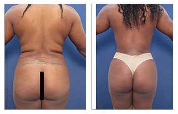 Brazilian buttock lift revision surgery