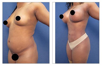 high definition liposuction front left view