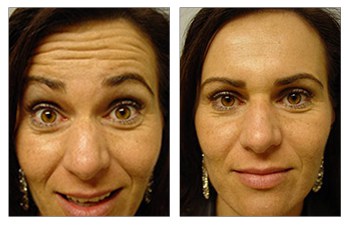 botox allergan before and after