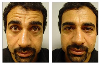 botox surgery before and after