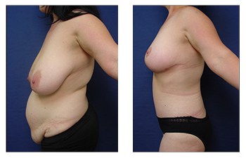 Breast lift with tummy tuck