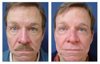 Laser Resurfacing Before and After