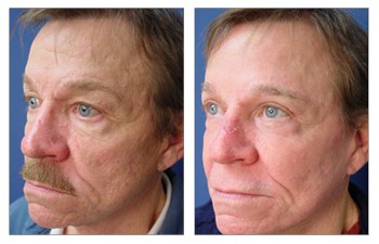 Laser Resurfacing Before and After