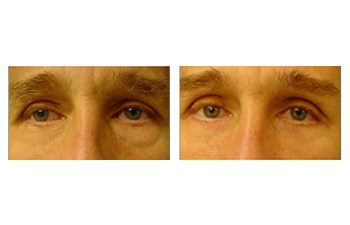 Lower Eyelid Anatomy