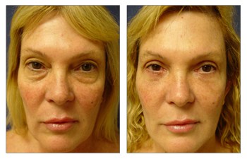 lower eyelid surgery patient 2005 before and after front view
