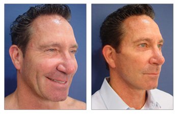 male upper blepharoplasty