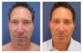 face and neck lift with general anesthesia Beverly Hills