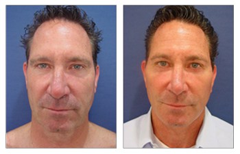 Upper eyelid deals surgery cost