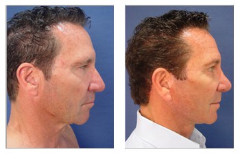 face and neck lift with general anesthesia Dana Point