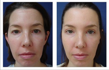 Eyelid skin clearance