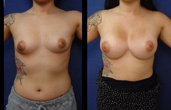 Natural Breast Augmentation (NBA)