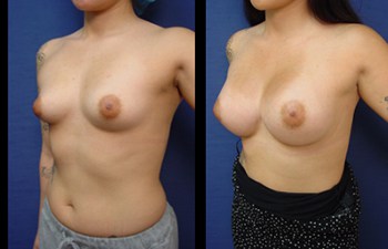 Natural Breast Augmentation (NBA)