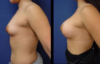 Breast lift Laguna Beach