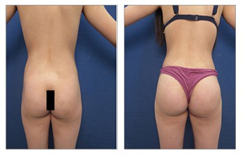 Buttock Lift vs. Butt Implants vs. BBL: What's the Difference