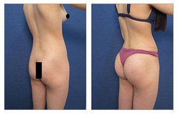 Before & After Lipo360 & BBL. This great patient sent us her