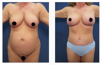 breast lift patient 1 front view