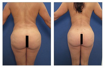 Brazilian Butt Lift  Sound Plastic Surgery, Cosmetic Plastic Surgery  Clinic Seattle