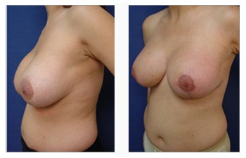 Breast Augmentation Revision Specialist