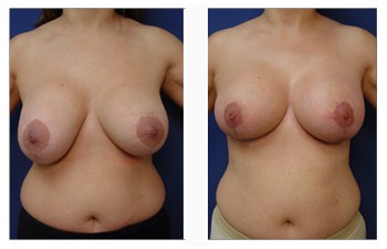 Breast Augmentation Revision Specialist