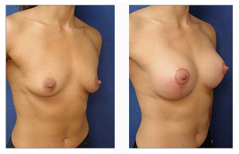 Breast Lift with minimal Implants Scars
