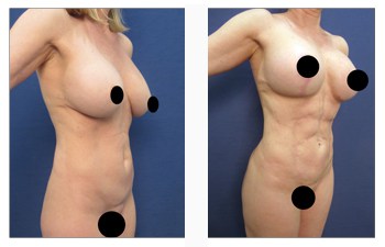 breast lift with implants revision