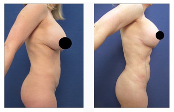 breast lift with implants revision