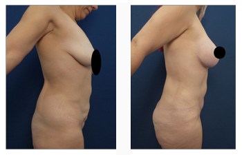 Breast Lift with Implants Price Cosmetic Plastic Surgery