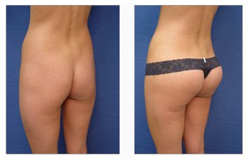 butt implant patient back left view