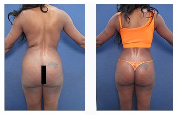 Will Lower Back Liposuction Also Address The Flanks?