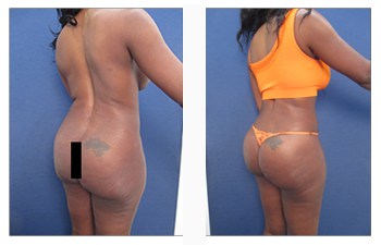 The importance of doing liposuction of the lower back and flanks during a  tummy tuck