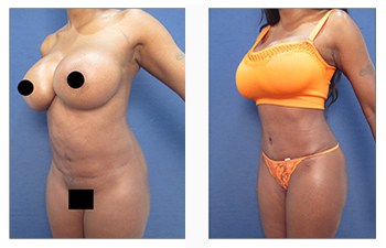 Body contouring's latest frontier: High-definition liposuction