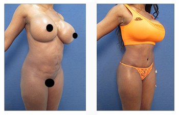 VASER 4D Hi-Def Lipo of the Flank - Liposuction of the Flanks