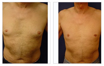 Male Back Liposuction SurgiSculpt