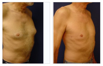 Gynecomastia Before & After, Case 10