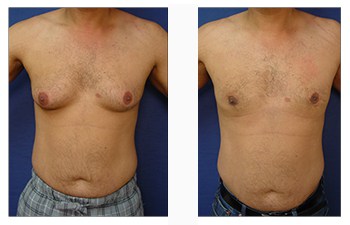 Male Breast Reduction for Gynecomastia in Orlando, FL - DrGeorge Pope