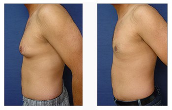 Puffy Nipples and Gynecomastia - Orange County, Newport Beach - Male Breast  Reduction