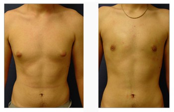 Gynecomastia Surgery Scars