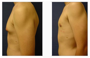 Gynecomastia Surgery Scars | Cosmetic Plastic Surgery