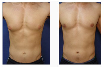 Breast Reduction For Men, Our Surgical Team