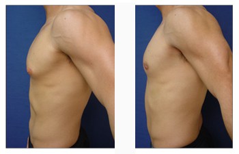Breast Reduction For Men
