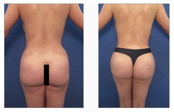 Buttock Enhancement with Buttock Reduction