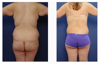 Body Lift Basics  Edina Plastic Surgery