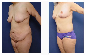 Body Contouring Before & After Photos - Orange County - Dr. Laguna