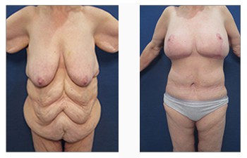 Do You Have Sagging Breasts After Losing Weight?