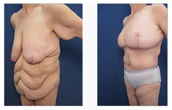 4 Breast Enhancement Procedures to Consider after Weight Loss