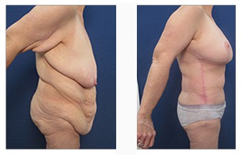 Excess skin problems among adolescents after bariatric surgery