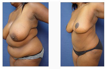 High definition liposuction Beverly Hills