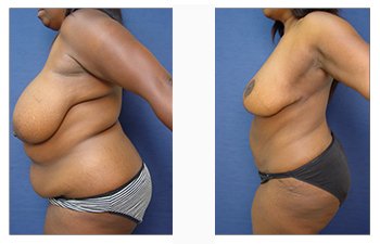 Body Lift Before and After Photos  American Society of Plastic Surgeons